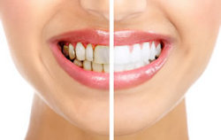 отбеливание эмали зубов